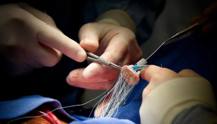 Biggest heart surgery, no incision, no anesthesia, valve replaced in front of patient's eyes